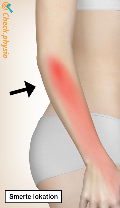 arm radialt tunnelsyndrom placering