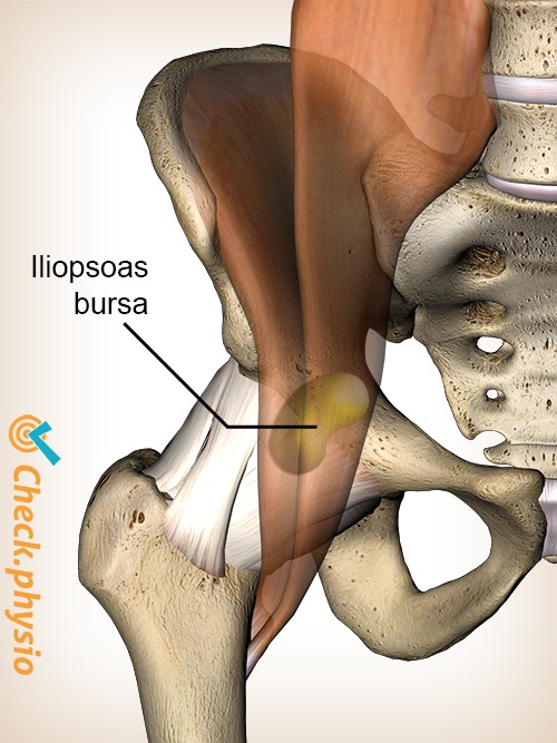 hofte iliopsoas bursa bursitis