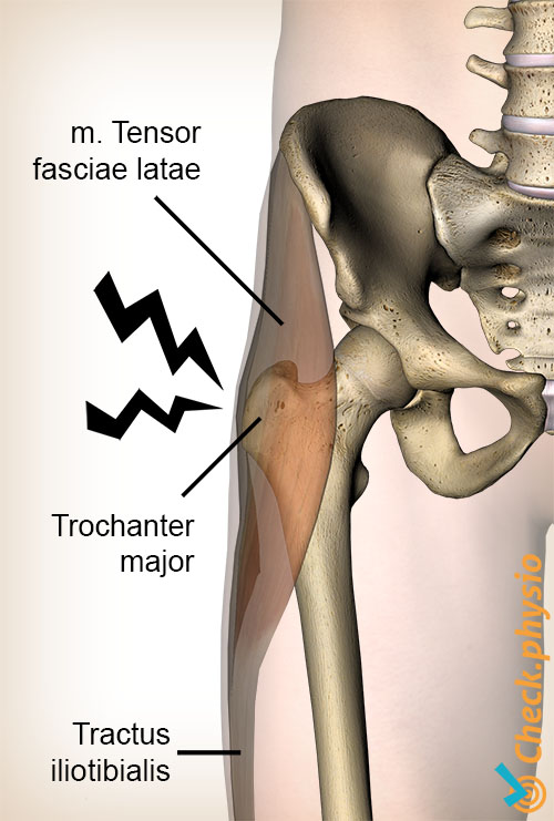 hofte greater trochanter smertesyndrom anatomi tensor fasciae latae tractus iliotibialis