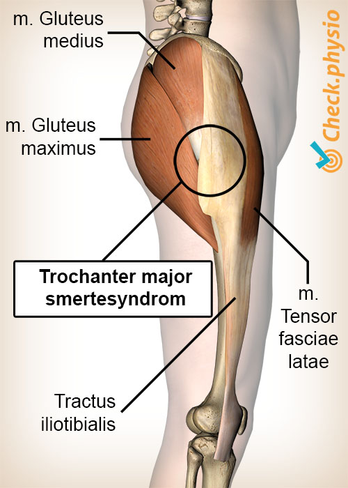 hofte greater trochanter smertesyndrom anatomi