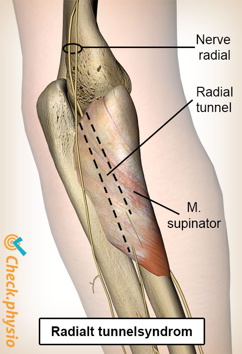 arm radial tunnel nervus radialis