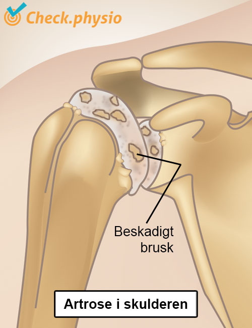 skulder slidgigt