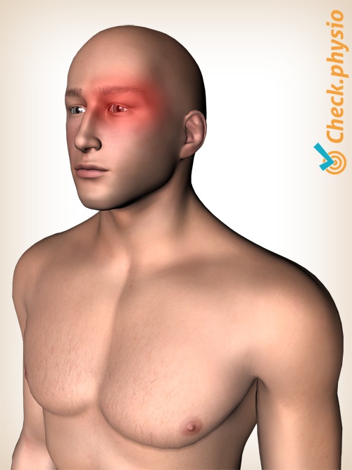 hoved klyngehovedpine neuralgi Horton smertelokation