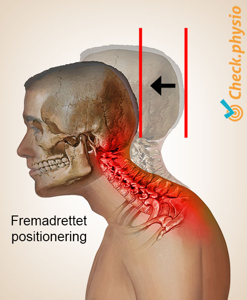 hoved nakke cervikalt holdningssyndrom anteroposition