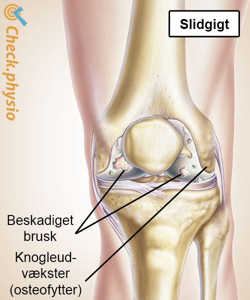 knæ artrose slitage brusk