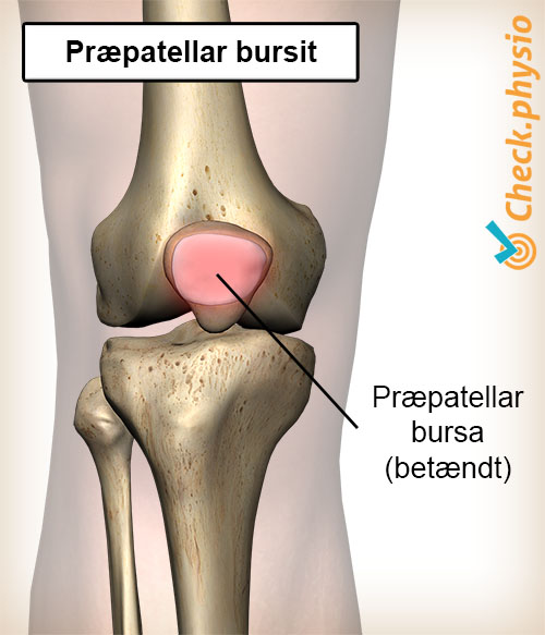 knæ bursitis præpatellaris betændt bursa slimsæk knæskal
