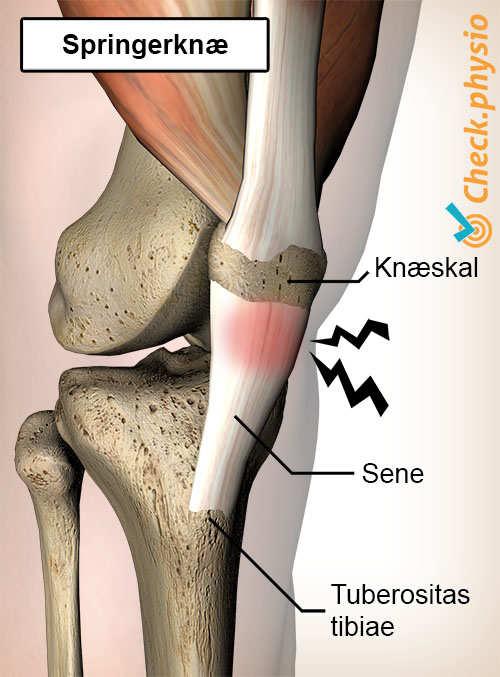 knæ jumpers knee smerte patellasene senebetændelse