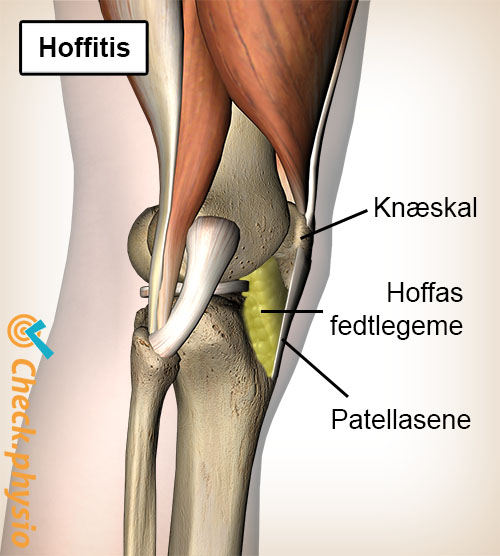 knæ Hoffas fedtpude hoffitis fedtlegeme