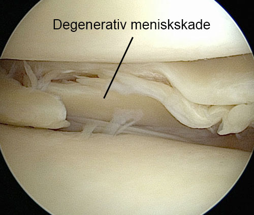knæ menisk degeneration degenerativ