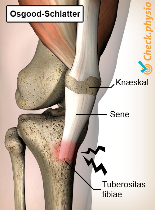 knæ osgood schlatter smerte patellasene