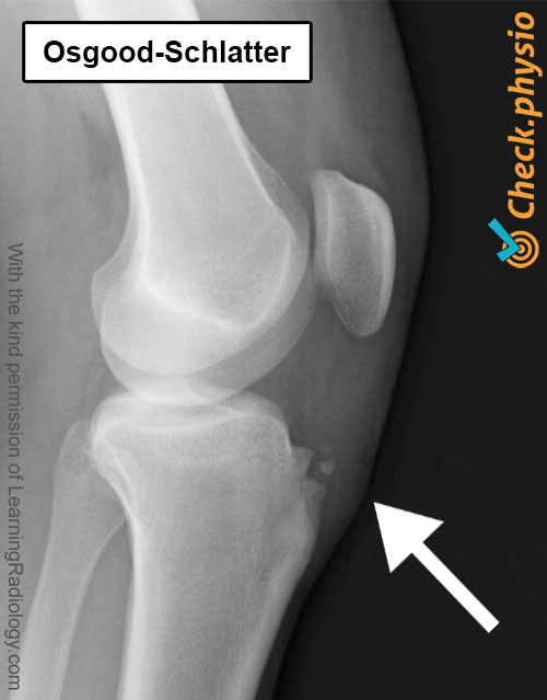 knæ osgood schlatter røntgen
