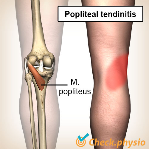 knæ popliteus tendinitis