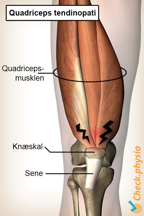 knæ quadriceps tendinopati anatomi
