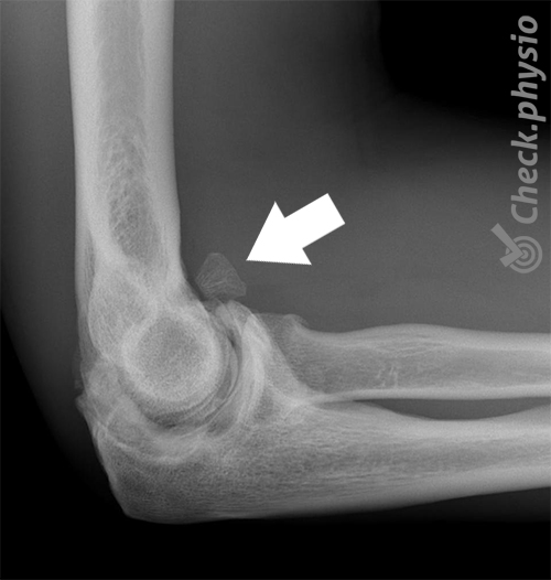 ossificerende myositis arm