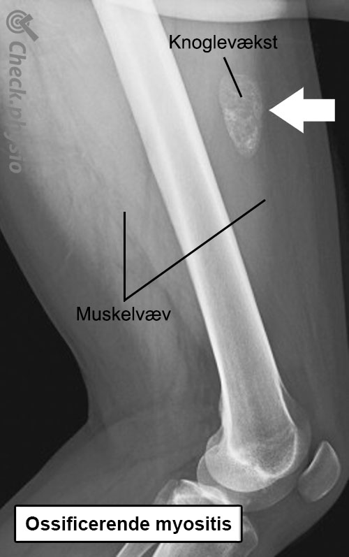 ossificerende myositis røntgenbillede anatomi
