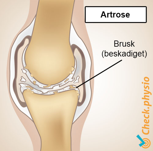artrose anatomi nedslidt