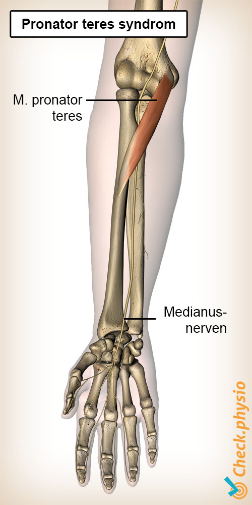 underarm pronator teres syndrom muskel nervus medianus nerve