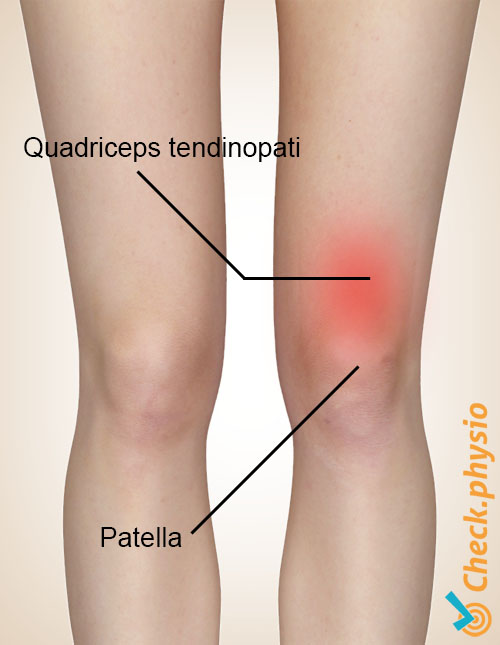 quadriceps tendinopati