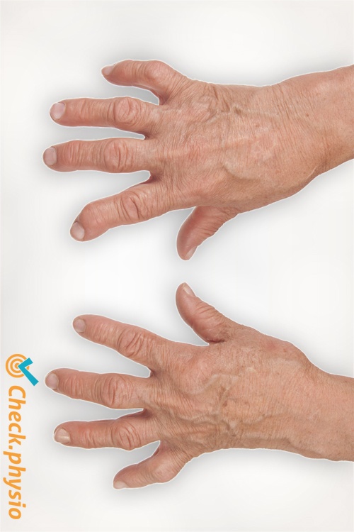 reumatoid artrit fingre