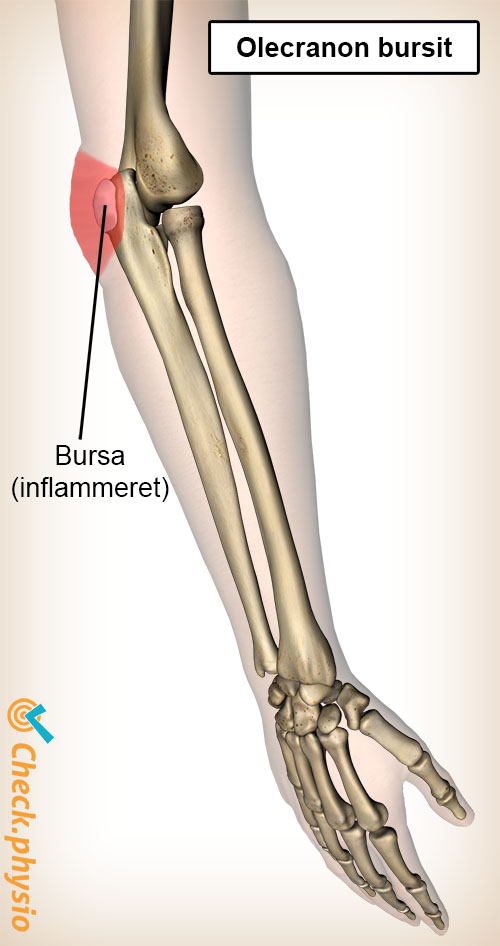 arm olecranon bursitis anatomi