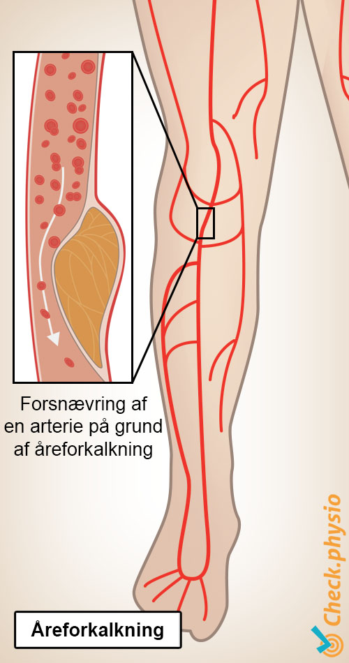 ben vindueskiggersyndrom claudicatio intermittens plakdannelse