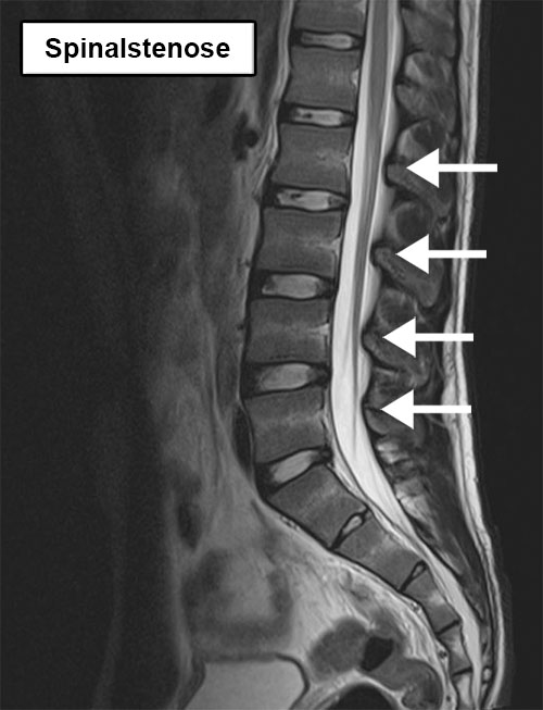 ryg lumbal rygsøjle røntgen spinal kanal stenose