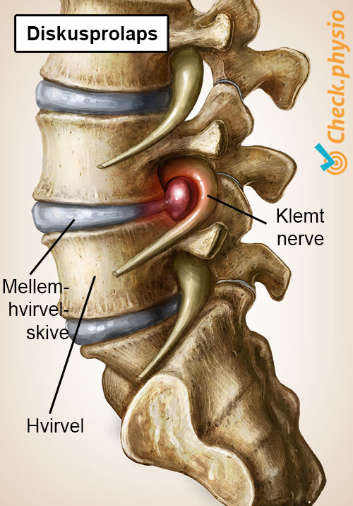 ryg specifik lændesmerter diskusprolaps