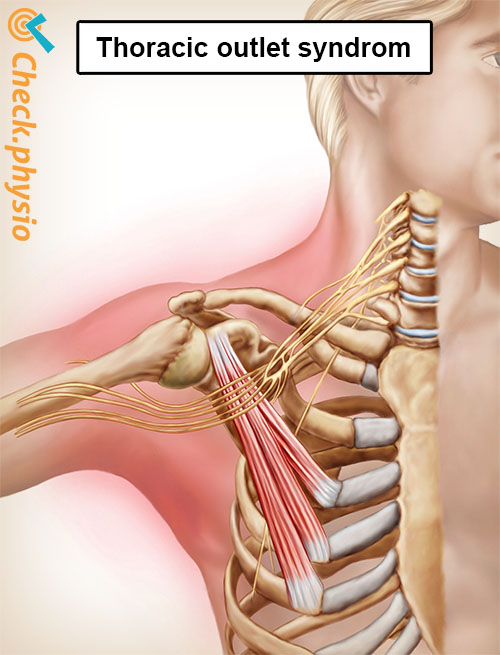 skulder arm hånd thoracic outlet syndrom anatomi