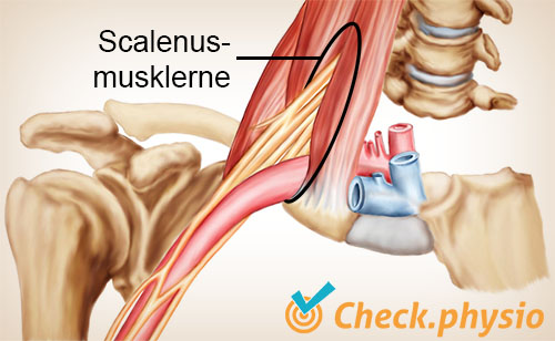 skulder arm hånd TOS thoracic outlet syndrom scaleniport