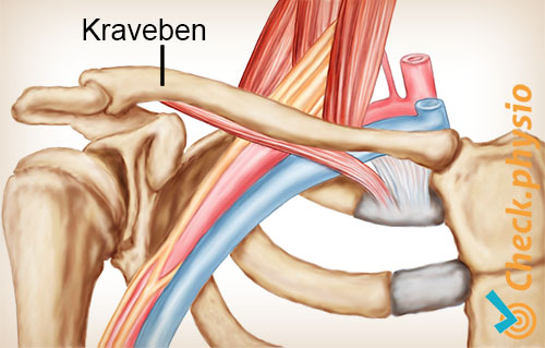skulder arm hånd TOS thoracic outlet syndrom kraveben