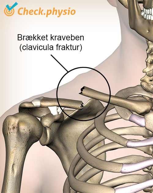 skulder klavikelfraktur brud på kraveben