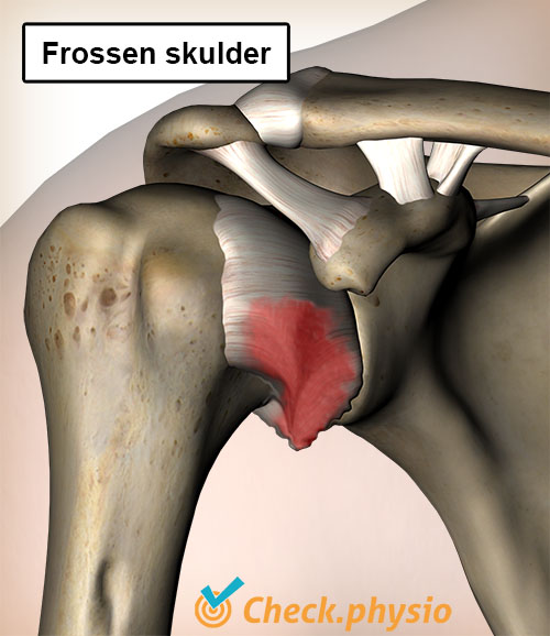 skulder frozen shoulder