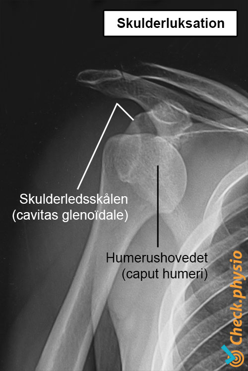 skulder røntgen luksation