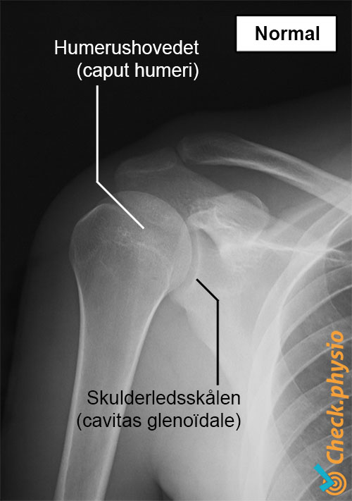 skulder røntgen normal