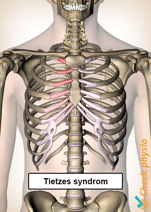 tietze syndrom ribben smerte bryst brystben