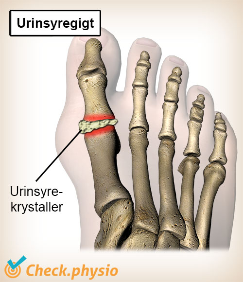 tå urinsyregigt urinsyrekrystaller