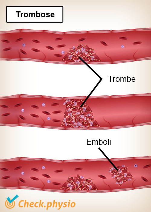 trombose trombe emboli blodkar vene arterie