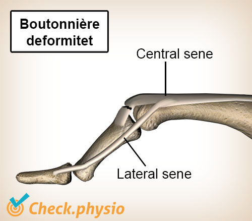 finger boutonnière deformitet ekstensorsene laterale slip centrale slip