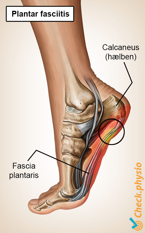 fod plantar fasciitis aponeurose hælspore