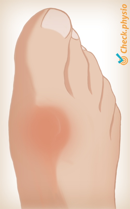 fod hallux rigidus billede