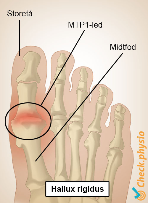 fod hallux rigidus storetå MTP1-led