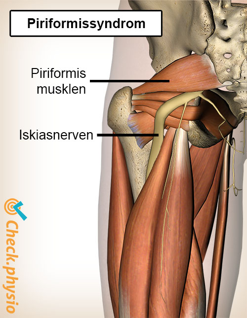 balle piriformis syndrom anatomi