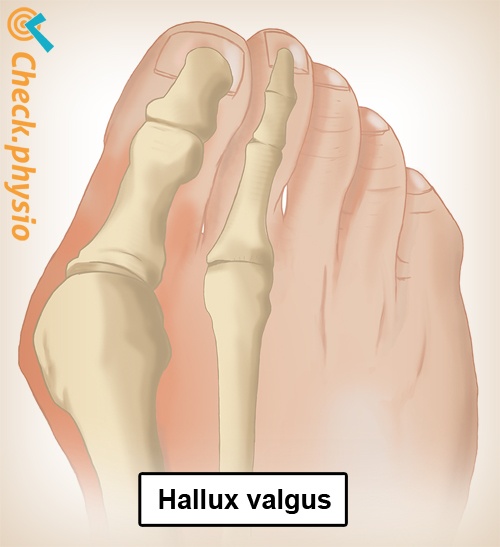 fod hallux valgus anatomi