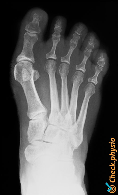 fod hallux valgus røntgen billede