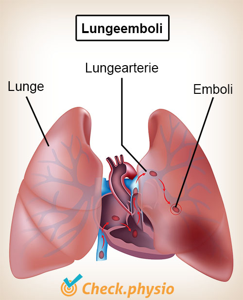 bryst lunger lungeemboli hjerte lungearterie