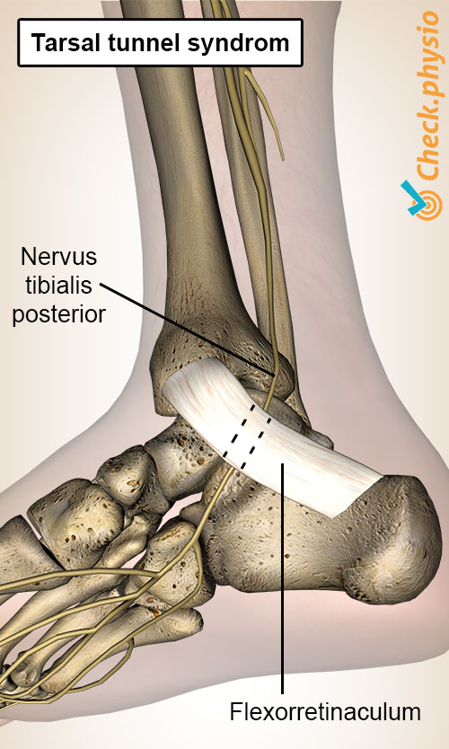 fod tarsalt tunnelsyndrom nervus tibialis posterior retinaculum flexorum