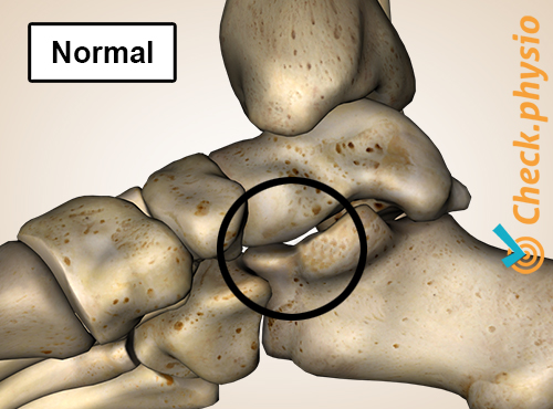 fod tarsal talocalcaneal koalition normal