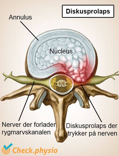 afbeelding_alt_wervelkolom-wervel-tussenwervelschijf-hernia-zenuwen