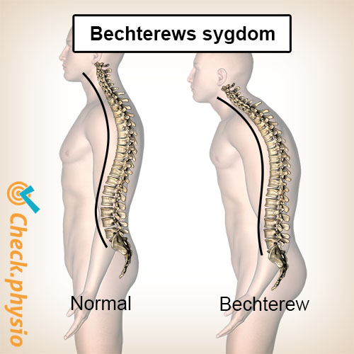 Bechterews sygdom kyfose krum ryg
