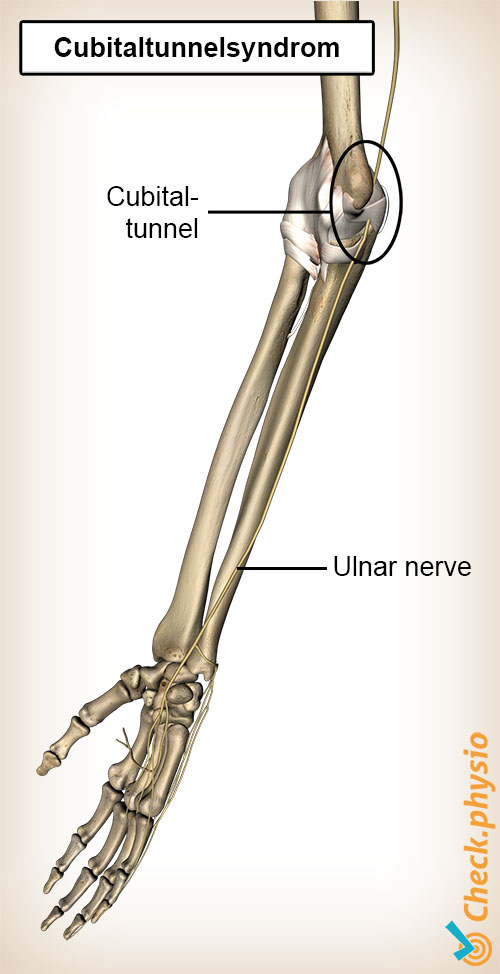 arm cubital tunnel nervus ulnaris
